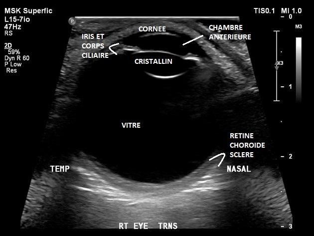 Échographie oculaire