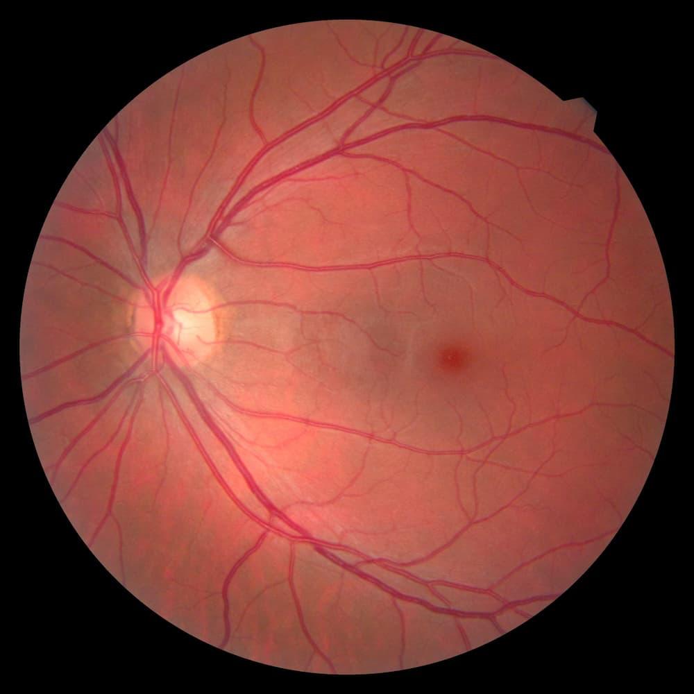 Rétinographie et Champ Visuel